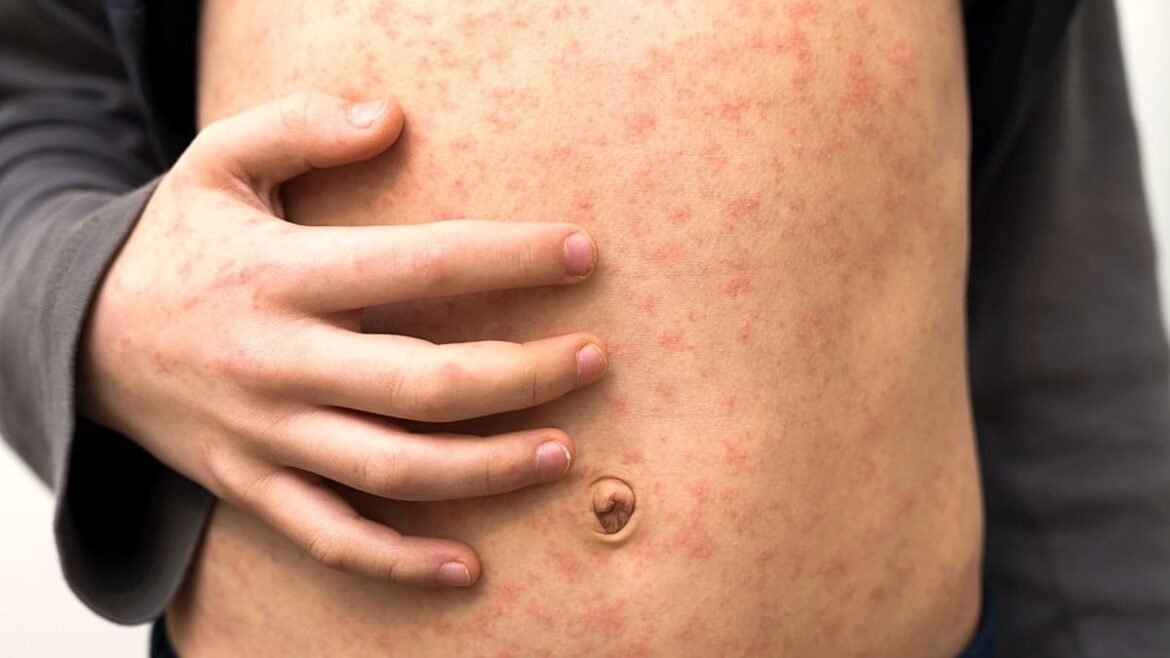Canada loses measles-free status after nearly 30 years
