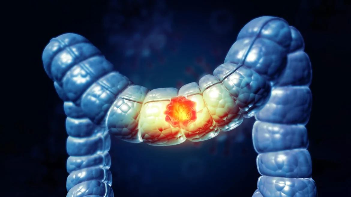 A stiffening colon may be fueling cancer in younger adults