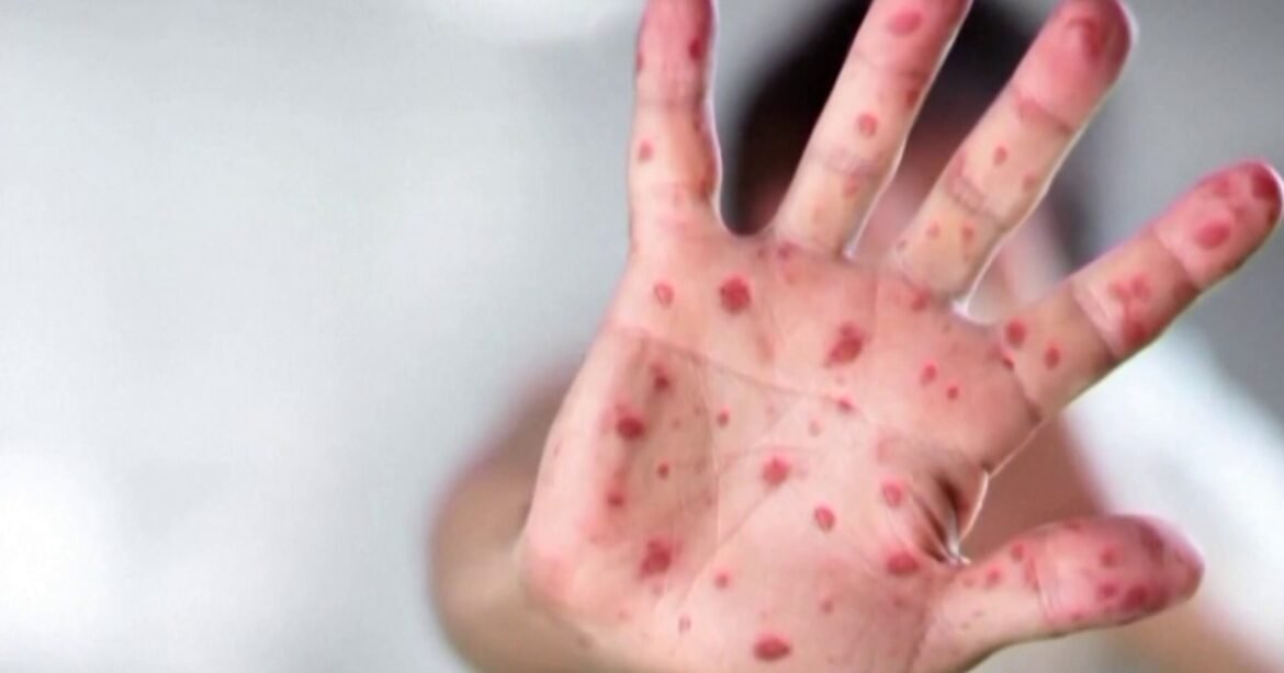 South Carolina Measles Outbreak Doubles in a Week
