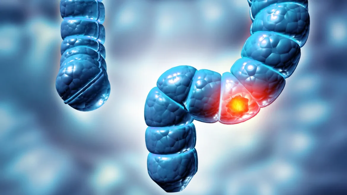 Study finds two types of colon polyps can raise bowel cancer risk fivefold
