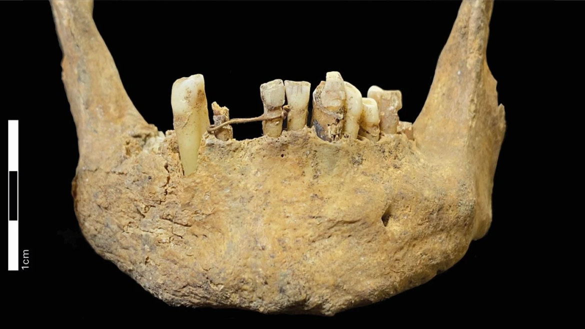 a human mandible seen from the front with a gold wire around two of the lower incisors