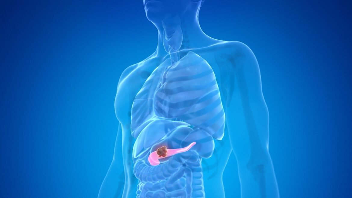 Illustration of pancreatic cancer in a human body.
