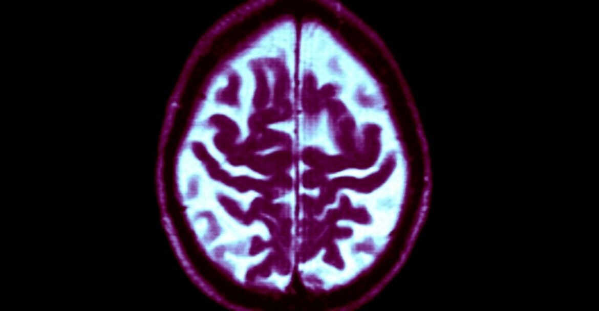 Dementia is rising, but your personal risk is falling