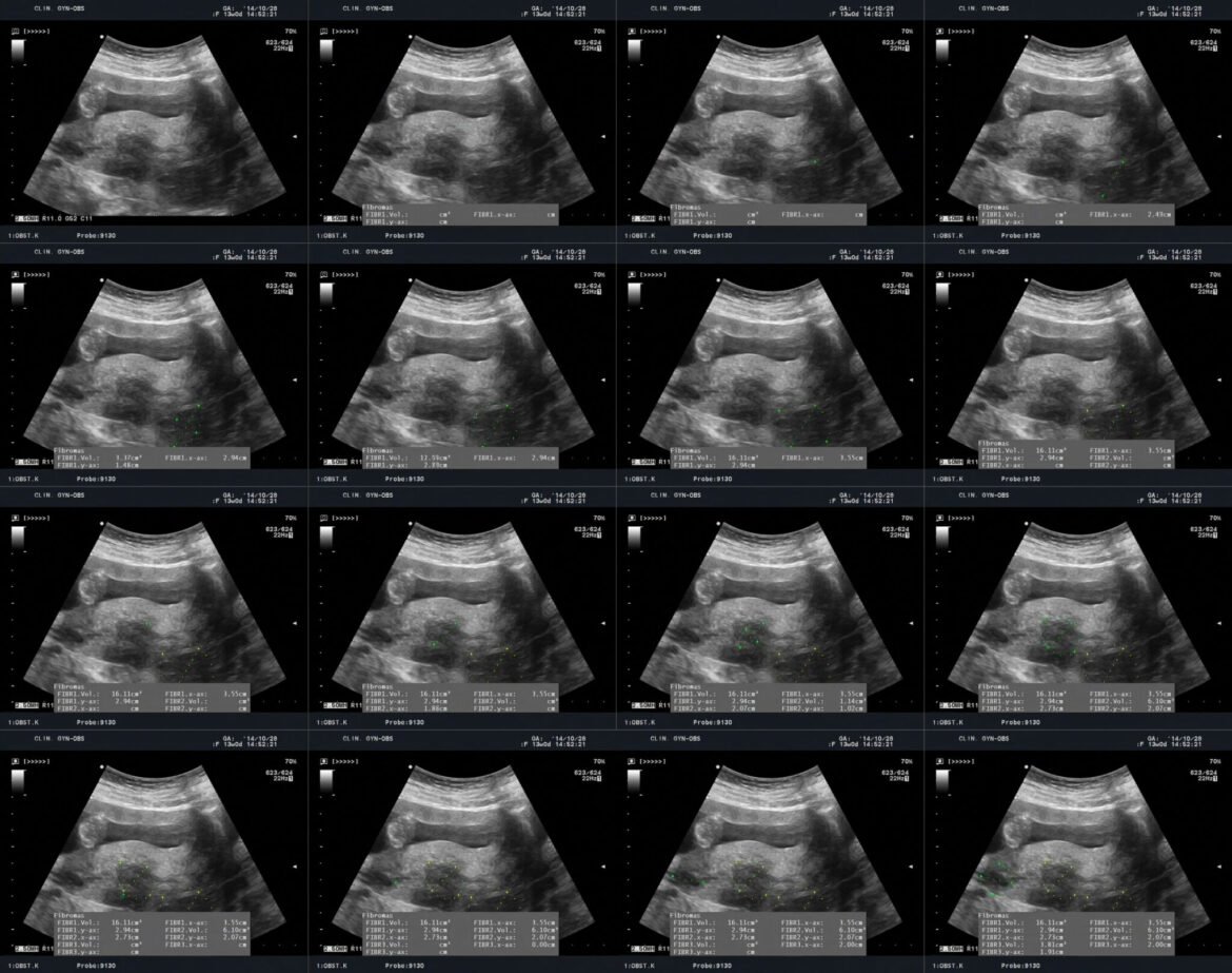NJ lawmakers, doctors seek to raise awareness of uterine fibroids • New Jersey Monitor