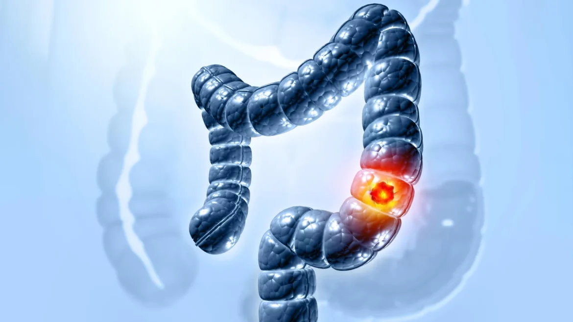 Scientists finally solved how a common gut bacterium triggers colon cancer