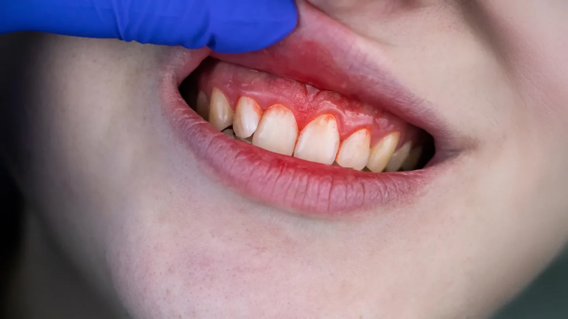 Common supplements rival antibiotics for severe gum disease