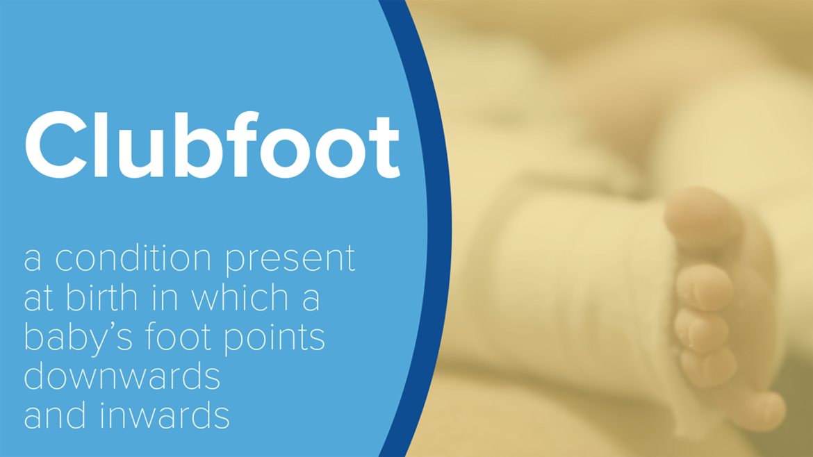 What Parents Should Know About Clubfoot Treatment | News