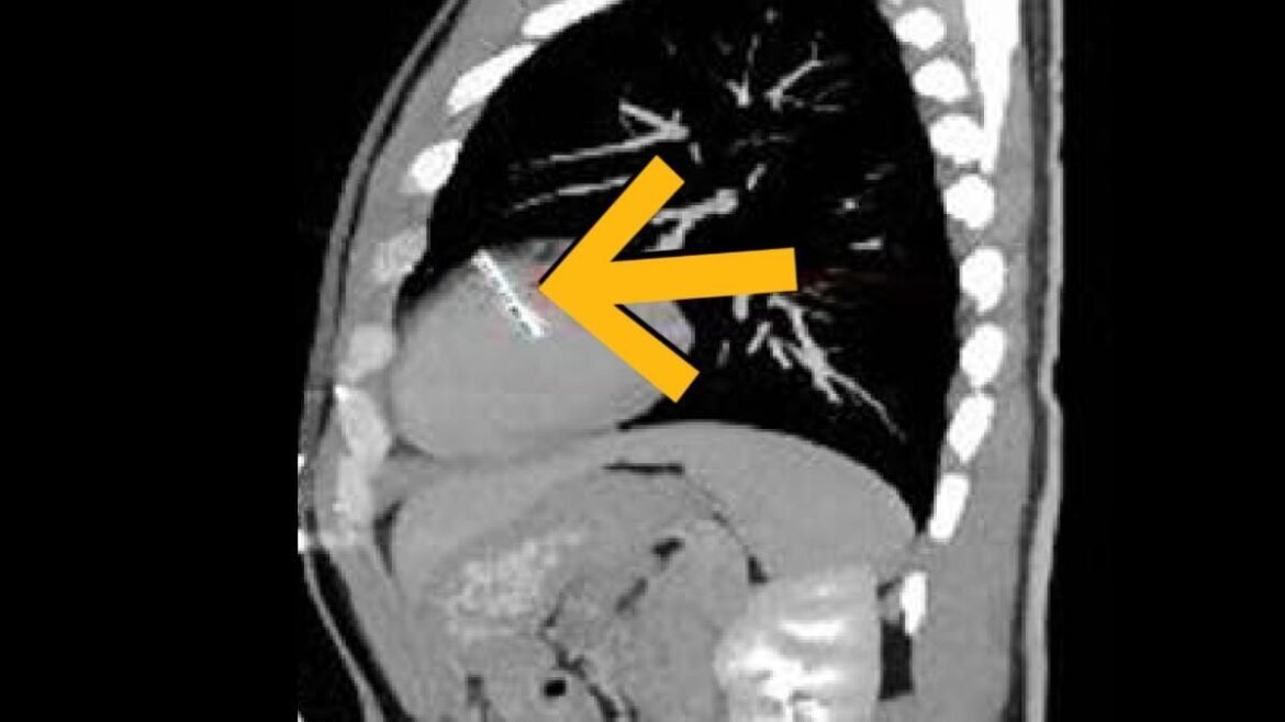A Man Went to Hospital With Blood in His Urine. Doctors Found a Needle in His Heart. : ScienceAlert