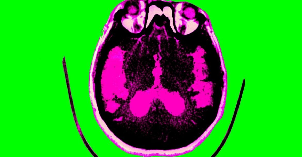 Good news about Alzheimer’s research, explained