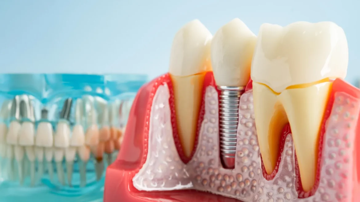 Dental implants can hijack your immune system, scientists discover