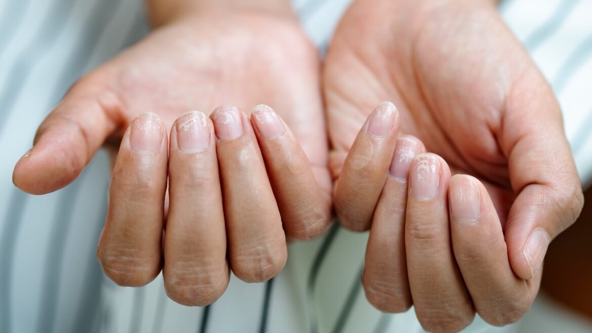 Some People Taking Ozempic-Like Drugs Are Reporting Their Fingernails Detaching : ScienceAlert